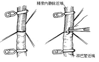 肾蒂淋巴管结扎、肾蒂淋巴管精索内（卵巢）静脉吻合术图片