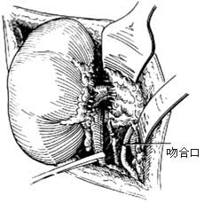 肾蒂淋巴管结扎、肾蒂淋巴管精索内（卵巢）静脉吻合术图片