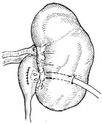 肾盂造瘘术和肾造瘘术图片