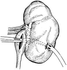 肾盂造瘘术和肾造瘘术图片