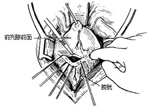 耻骨后根治性前列腺切除术图片