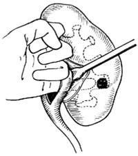 肾窦内肾盂切开取石术图片