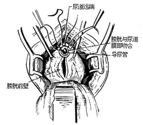 耻骨后根治性前列腺切除术图片