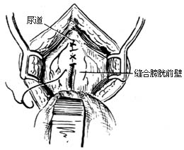 耻骨后根治性前列腺切除术图片