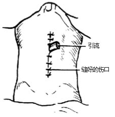 耻骨后根治性前列腺切除术图片