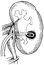 肾窦内肾盂切开取石术图片