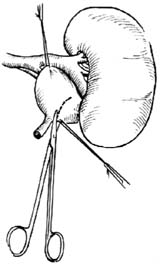 肾盂输尿管连接部成形术图片