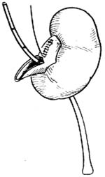 肾盂输尿管连接部成形术图片
