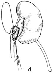 肾盂输尿管连接部成形术图片