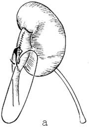 肾盂输尿管连接部成形术图片