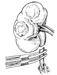 肾切除术图片