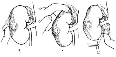 肾切除术图片
