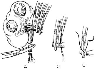 肾切除术图片