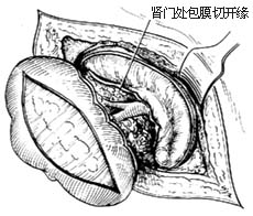 肾切除术图片