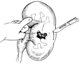 肾切开取石术图片