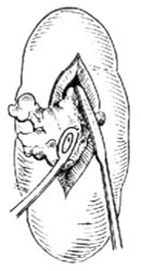肾切开取石术图片