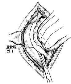 肾母细胞瘤切除术图片