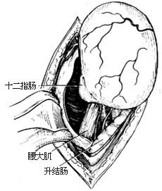 肾母细胞瘤切除术图片