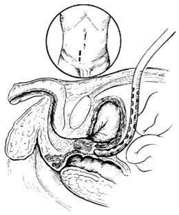 腹膜透析术图片