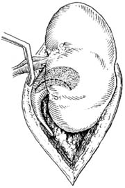 肾切开取石术图片