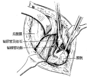 输尿管切开取石术图片