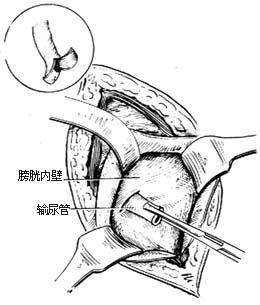 盆部输尿管吻合术图片