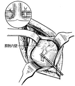 盆部输尿管吻合术图片