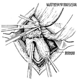 盆部输尿管吻合术图片