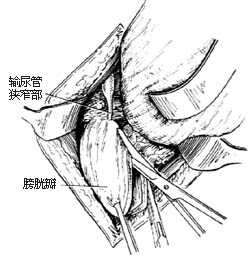 盆部输尿管吻合术图片