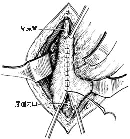盆部输尿管吻合术图片
