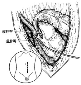 输尿管乙状结肠吻合术图片