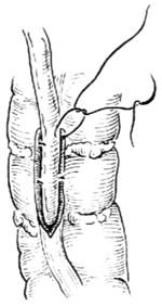 输尿管乙状结肠吻合术图片
