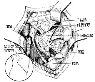 回肠代输尿管术图片