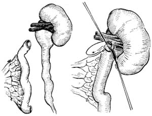回肠代输尿管术图片