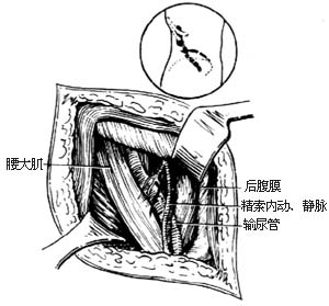 输尿管切开取石术图片