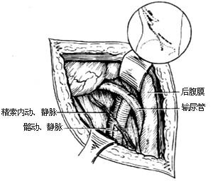 输尿管切开取石术图片