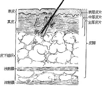 皮片移植术图片