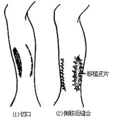 扁平皮瓣移植术图片