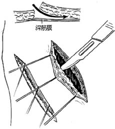 管状皮瓣（皮管）移植术图片