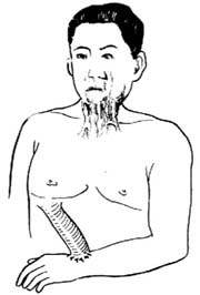 管状皮瓣（皮管）移植术图片