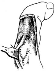手部烧伤瘢痕挛缩畸形修复术图片