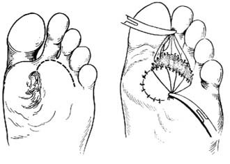 足底瘢痕或慢性溃疡切除修复术图片