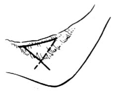 关节部位瘢痕挛缩畸形修复术图片