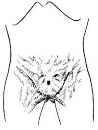 会阴部瘢痕挛缩畸形修复术图片