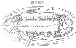 椎管-脊髓探查术图片