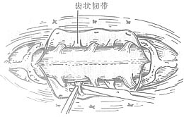 椎管-脊髓探查术图片