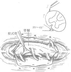 椎管-脊髓探查术图片