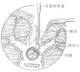 椎管-脊髓探查术图片