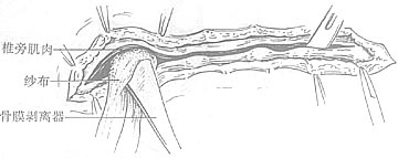椎管-脊髓探查术图片