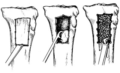 松质骨移植术图片